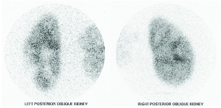 renal perfusion scan